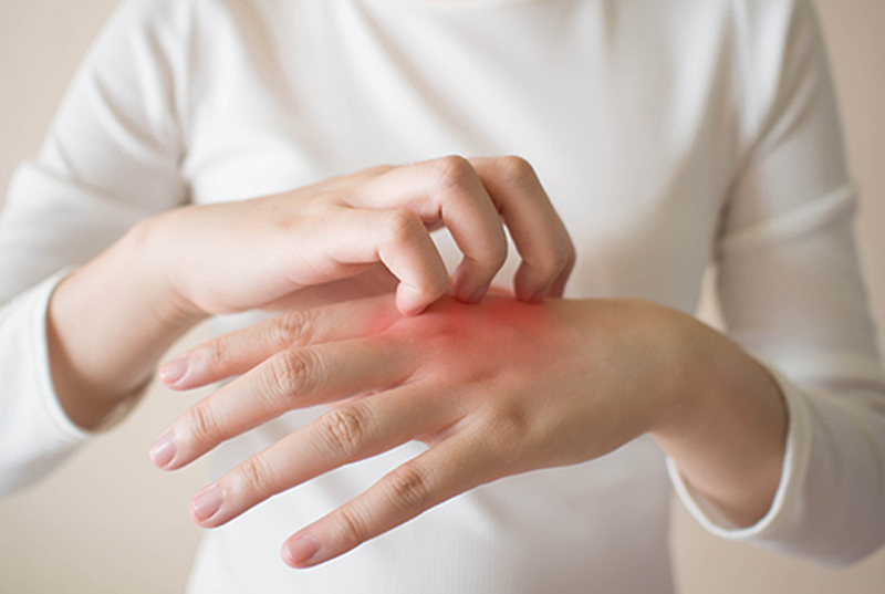 Eczema