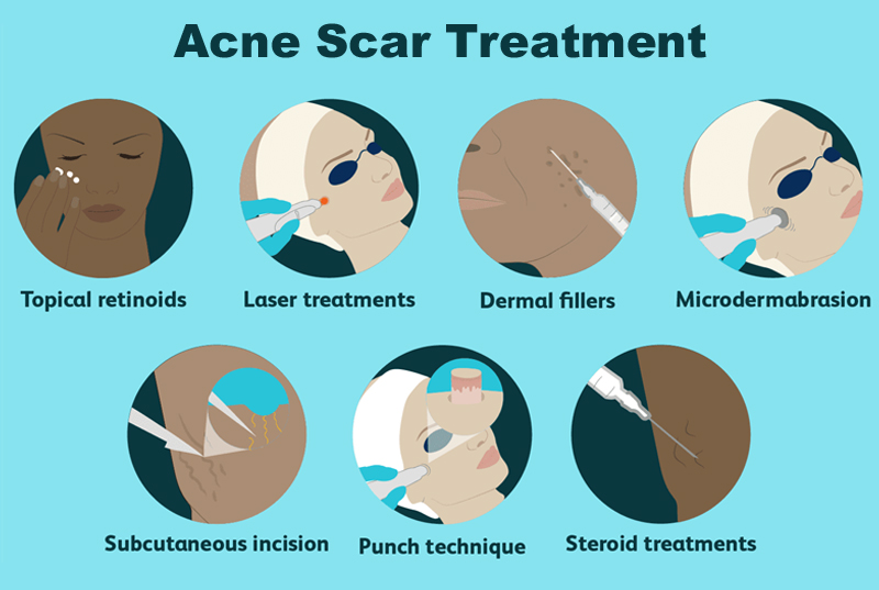 Acne Scar