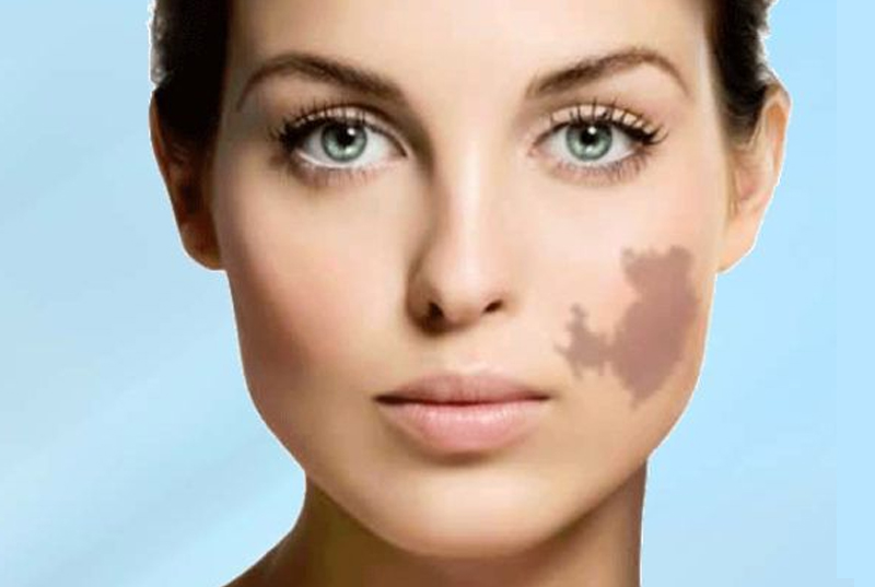 Birthmark Removal