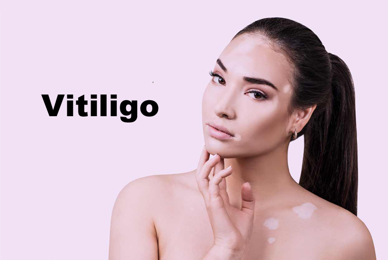 Vitiligo
