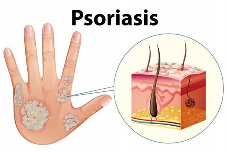 Psoriasis