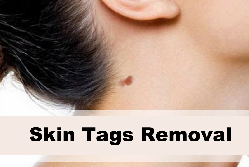 Skin Tags